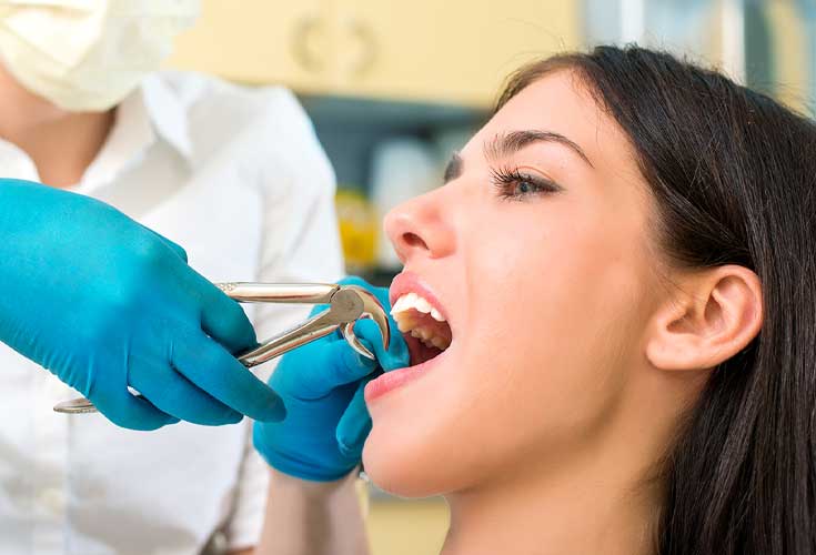 Tooth Extraction