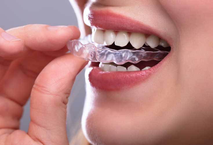 Invisalign Dentist Brisbane