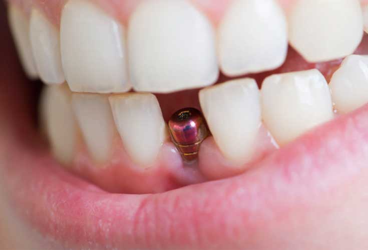 Dental implants Brisbane