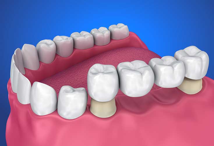 Dental Crowns and Bridges