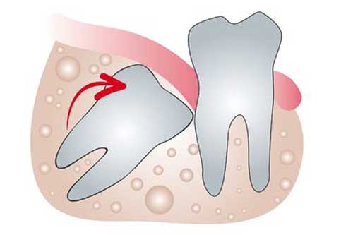 Wisdom Tooth Removal