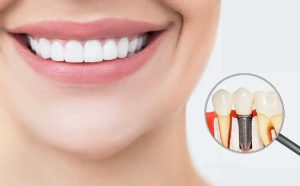 How much does a dental implant cost in Rochedale, Queensland?